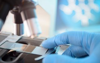 The Evolution of Active Surveillance in Prostate Cancer
